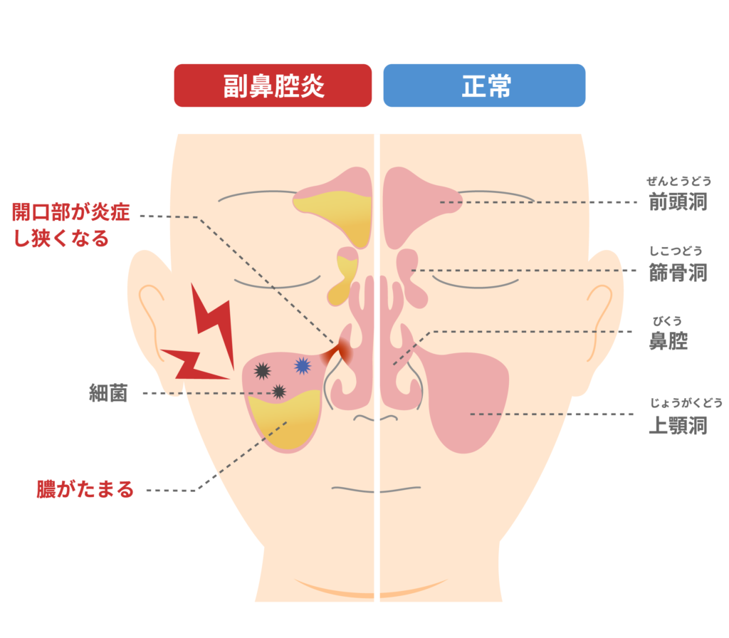 副鼻腔炎